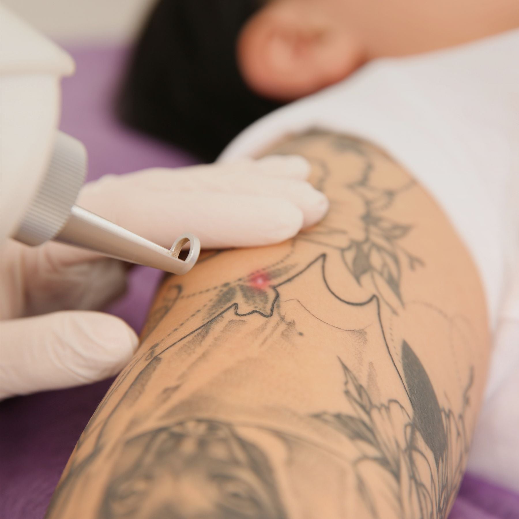 A laser device is applied to a floral and portrait tattoo on a person's upper arm.