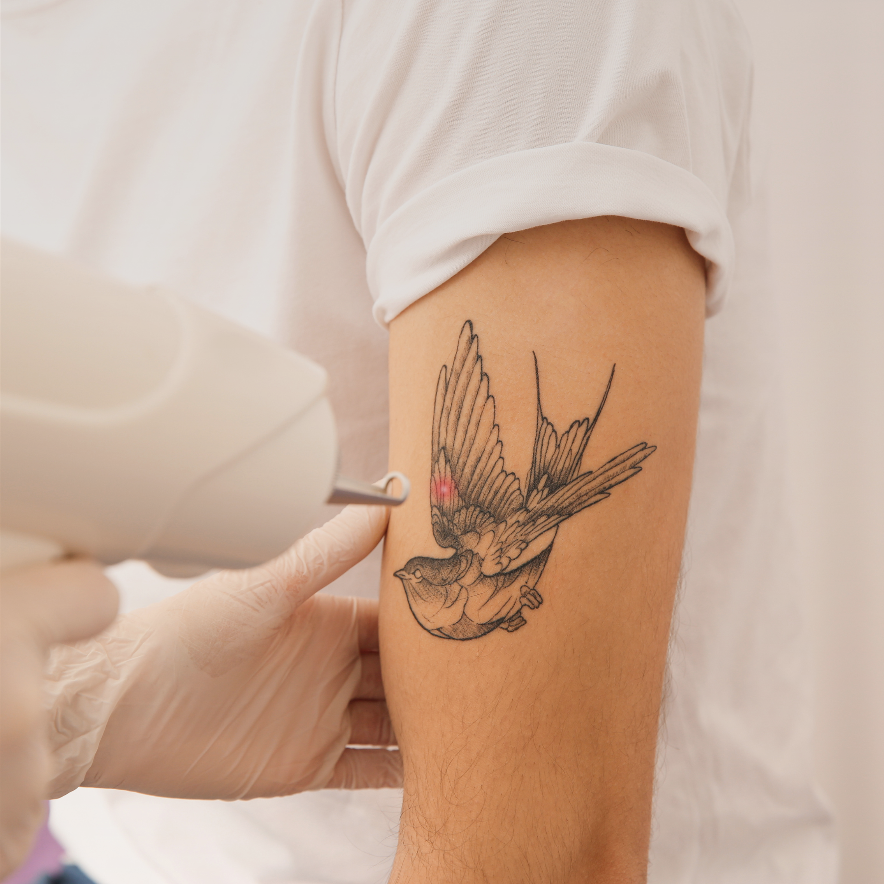 A close-up of a person receiving laser tattoo removal on a black and grey bird tattoo on their upper arm. A technician wearing gloves holds a laser device aimed at the tattoo, with small red marks visible on the inked area.